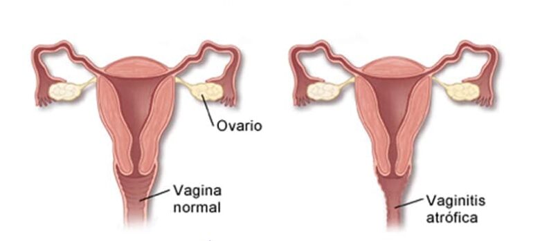 Atrofia vaginal